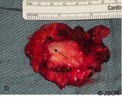 The en bloc specimen with the IVC surface in the foreground and the left adrenal vein clearly visible (arrow).