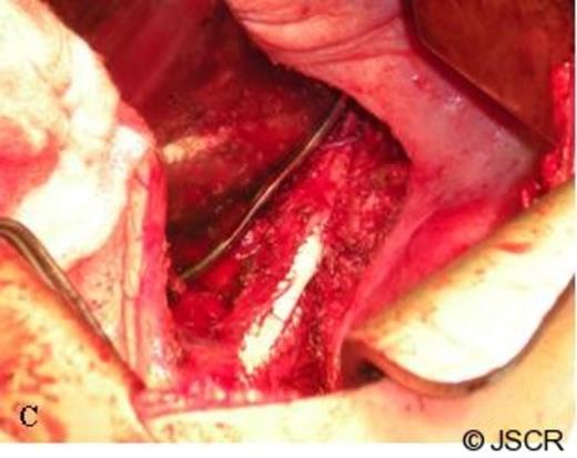 The PTFE graft sewn onto the IVC after the mass was removed
