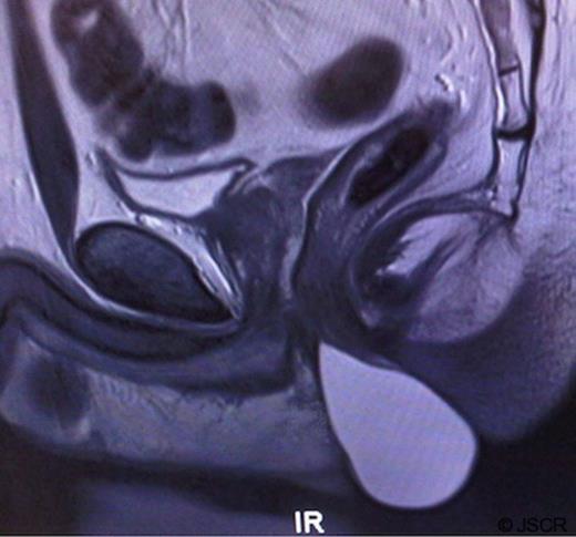 MRI of the pelvis showing a large cystic mass arising from the intersphincteric plane, lying anterior to the anal canal.