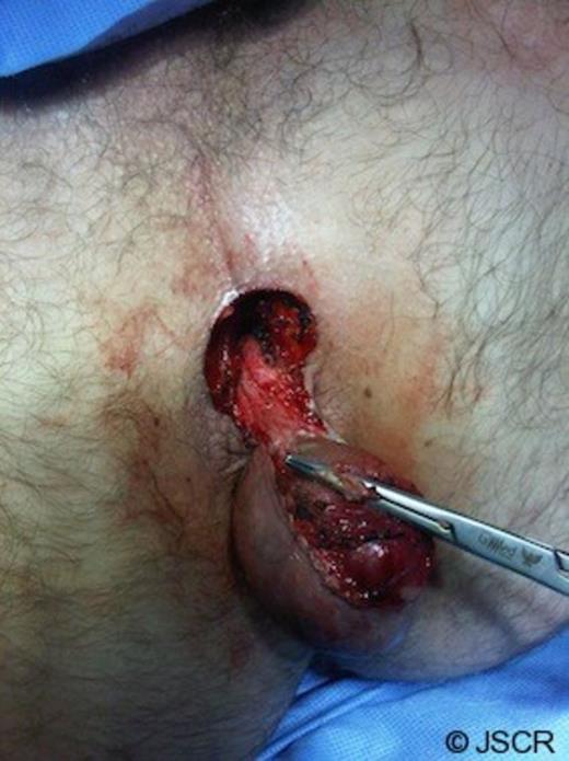 Intraoperative image of perineum