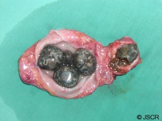 Excised and opened gallbladder