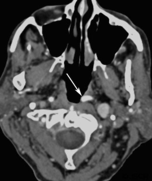 Contrast enhanced axial computed tomography of parapharyngeal region showing left retropharyngeal mass (arrow)
