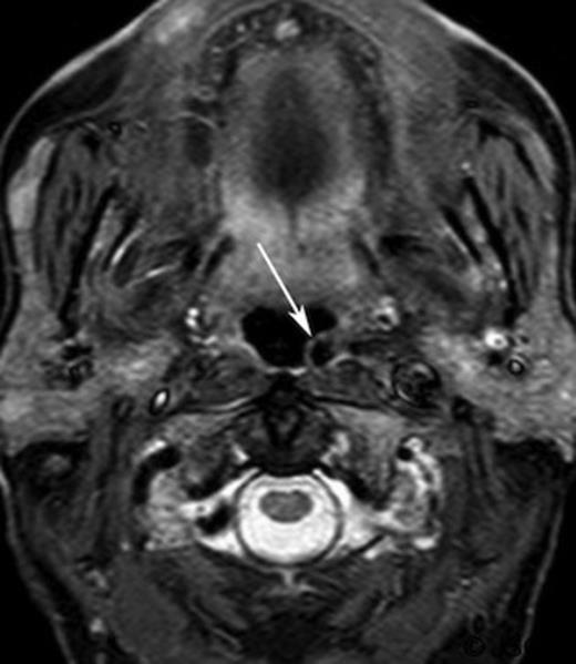 Short inversion time inversion recovery (STRI) axial magnetic resonance imaging of the retropharyngeal region (arrow)