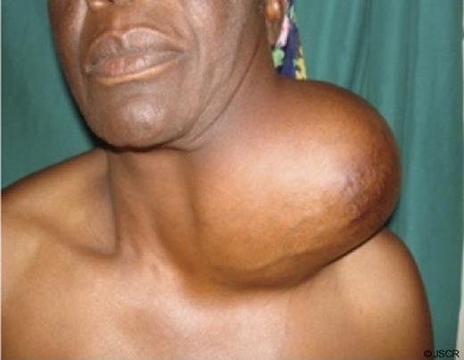 Gigantic cysticercosis pseudo tumour of the neck which had grown up gradually over decades.