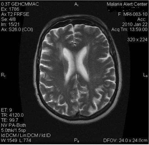 MRI of the brain revealed no masses which generally ruled out brain involvement (Neurocysticercosis)