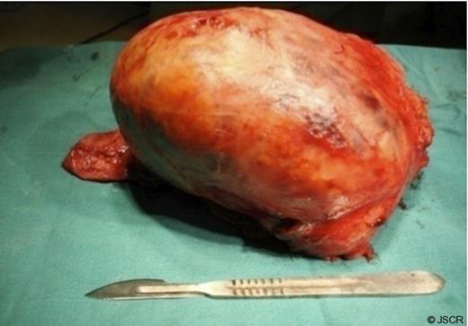 An extraordinary huge cysticercosis pseudo tumour weighing 1.5kg was completely excised.