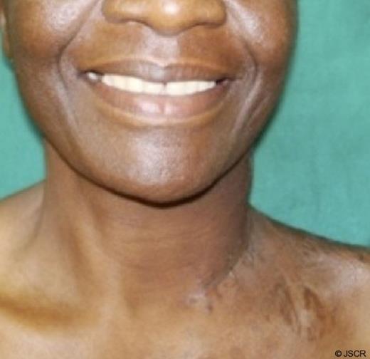 Few weeks after surgery, generally patient had uneventful recuperation