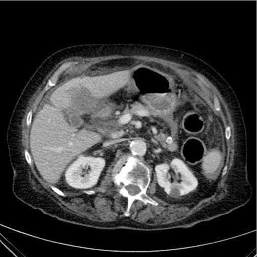 CT Scan demonstrating a thick walled gallbladder with free fluid in the paracolic gutter and a collection in the porta hepatis