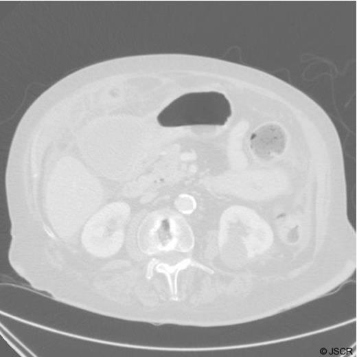 CT Scan demonstrating a gastric duplication cyst