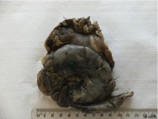 Histological specimen demonstrating the cyst overlying the stomach