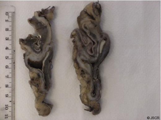 Specimen demonstrating a gastric duplication cyst in the gastric lining