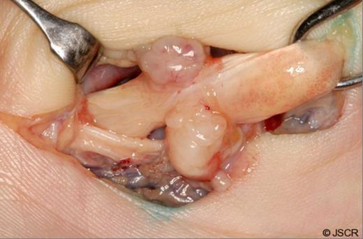 Intraoperative picture of flexor pollicus longus with fibromatosis nodules.
