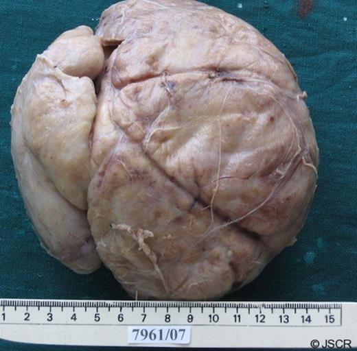 The enucleated specimen: Note the smooth outer surface denoting the well circumscribed nature of the mass.