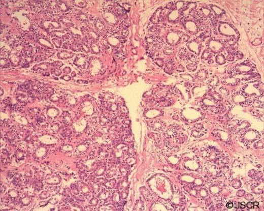 H&E, X 100. Hyperplastic acini retaining normal lobular configuration.