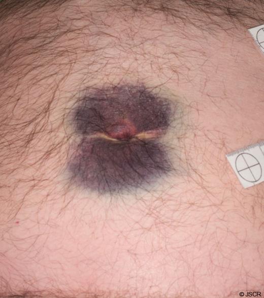 Periumbilical bruising, Cullen’s sign.