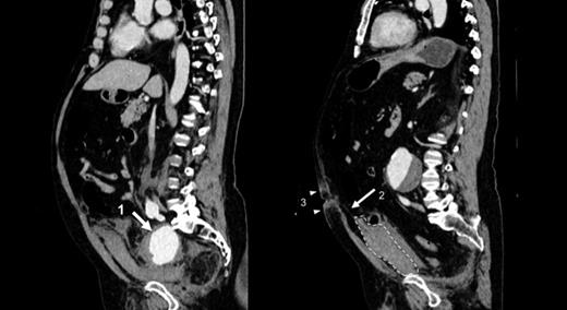 Sagittal views of CT Abdomen-pelvis showing internal iliac artery aneurysm (Arrow 1) and haematoma formation anterior to the bladder (Enclosed dotted lines) with blood tracking up the lateral umbilical ligament (Arrow 2) towards the umbilicus causing Cullen’s sign (Arrow heads 3).