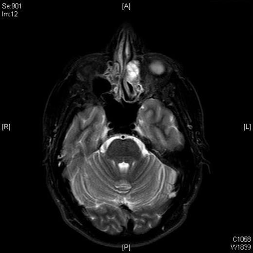 T1 weighted MRI scan showing left ethmoid tumour