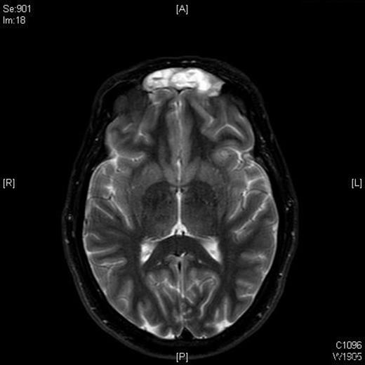 T1 weighted MRI scan showing tumour in frontal sinuses