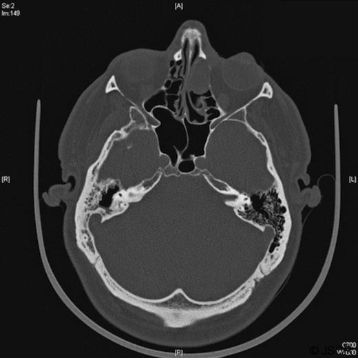 CT scan of tumour in left ethmoid sinus