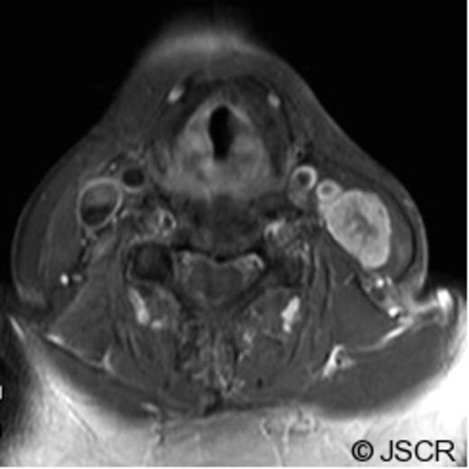 MR and CT Neck findings of the surgical pathway recurrence of a clival chordoma. (Axial, T1-weighted with Gadolinium MR image). Image obtained at the time of presentation with the neck mass, show a large, heterogeneous level III neck mass (23 mm x 17mm) with infiltration throughout the sternocleidomastoid muscle without obvious invasion of the great vessels. A few surrounding rounded lymph nodes within normal size limits are seen.