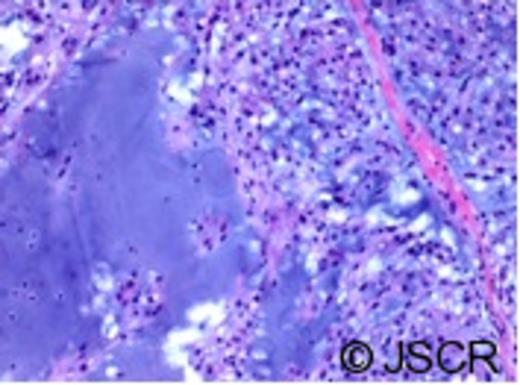 Histological appearance of chordoma. The tumour is composed of lobules of large cells with vacuolated cytoplasm admixed with a myxoid stroma.