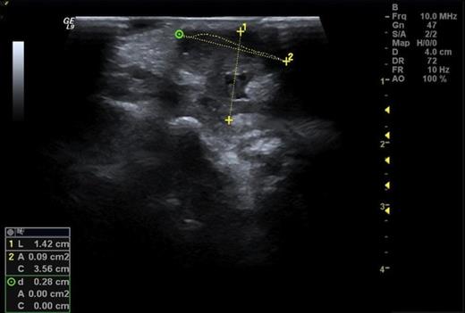 Ultrasound showing a synovial tumour on the dorsal medial aspect of the wrist