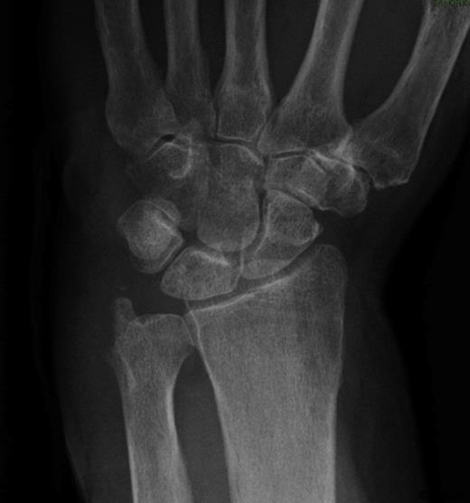 AP Xray of the wrist showing destruction of the ulnar styloid consistent with a bony infection. Soft tissue swelling can also be noted over the dorsum of the wrist