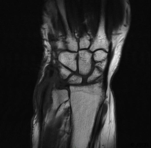 MRI showing localised destruction around the ulnar head. The MRI also shows thickening around the extensor carpi ulnaris tendon in keeping with marked tenosynovitis at this site.
