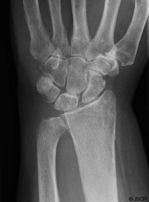 Post-operative Xray of the wrist showing excision of the ulnar styloid