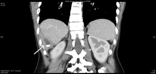 Abdominal CT scan showing a radio-opaque faecolith in the right upper quadrant (arrowed)
