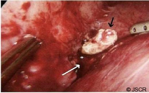 Appendicolith (black arrow) in the perihepatic abscess cavity (white arrow).