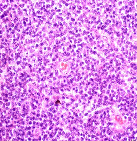 High power photomicrograph of the lymphoid infiltrate within the gall bladder wall. The population is monomorphous and comprised of small lymphocytes with a bland cytological appearance.