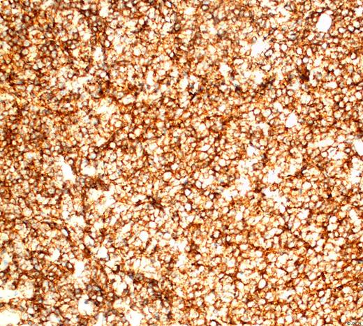 High power photomicrograph of an immunohistochemical stain for the CD20 antigen decorating small B-lymphocytes.