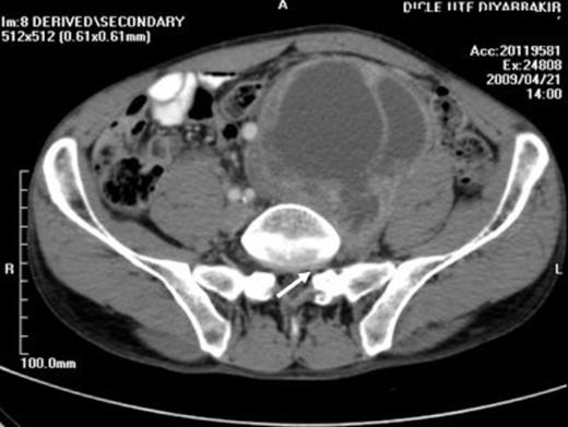 A CT image showing a heterogeneous, multilocular, cystic mass which is localized to the anteromedial aspect of the psoas muscle begining from the left L5 - S1 intervertebral foramina