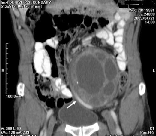 CT shows dilated left common iliac vein