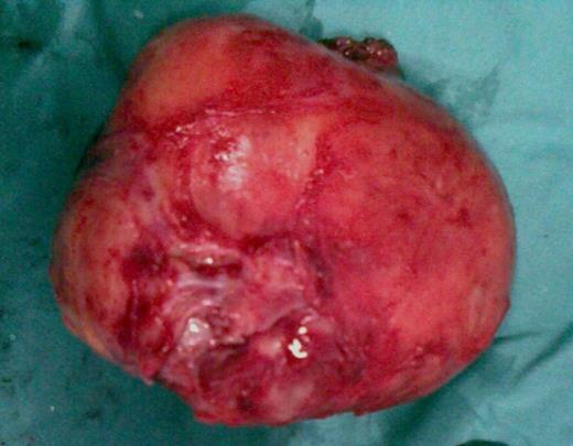 Macroscopic view of schwannoma