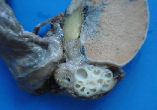 Well circumscribed multicystic mass within the epididymis