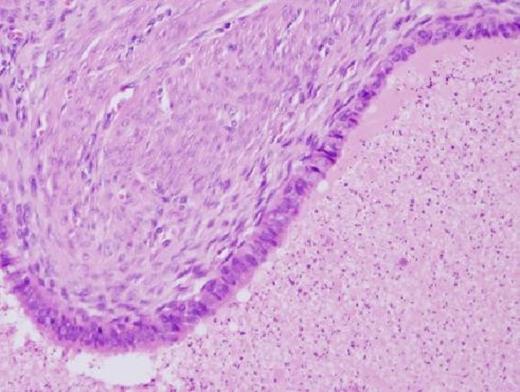 Columnar epididymal type epithelium lining a ductular structure with abundant spermatozoa within the lumen