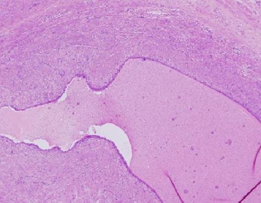 Cystic duct with surrounding cuff of hyperplastic smooth muscle