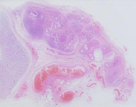 Low power view showing the mass blending with ducts in the epididymal tail