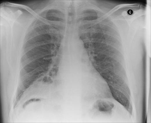 Chest radiograph taken shortly after admssion