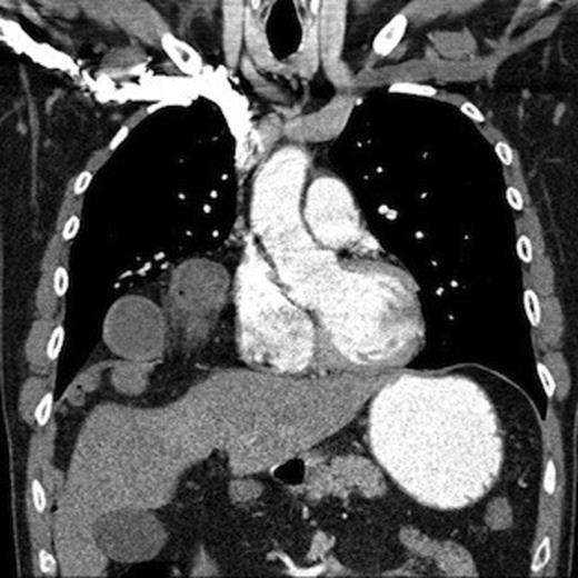 CT scan of chest & abdomen demonstrating diaphragmatic hernia