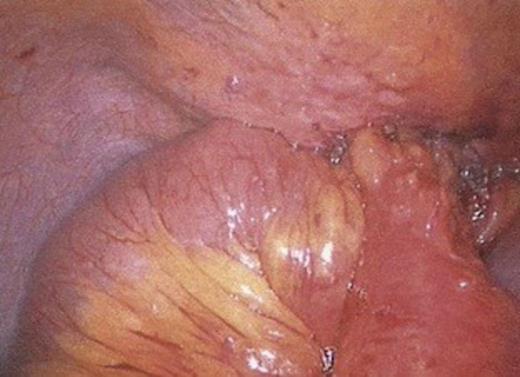 Small bowel & omentum seen entering hernial defect