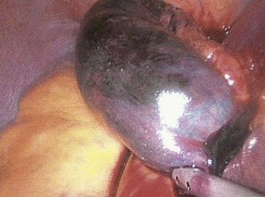 Necrotic small bowel removed from chest cavity