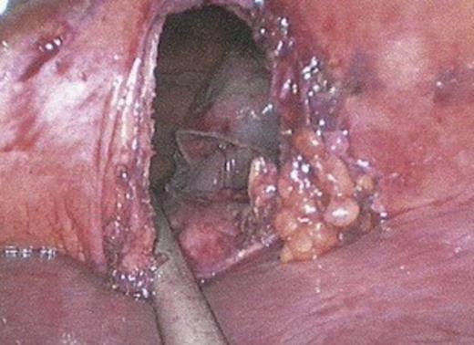 Diaphragmatic hernia defect. The right lung can be visualised through the defect