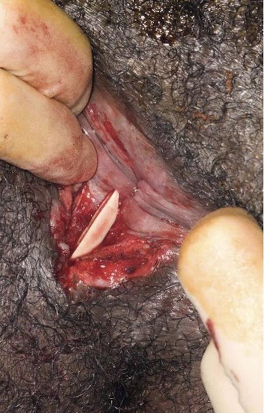 Subcutaneous perianal fistula containing fragment of pig bone