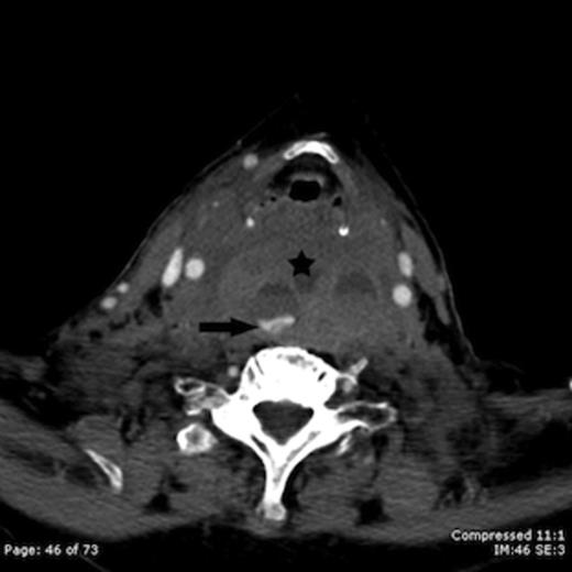Contrast enhanced axial CT image taken at the level of the hyoid bone shows a large retropharyngeal haematoma (star) with active intravenous contrast extravasation (arrow)