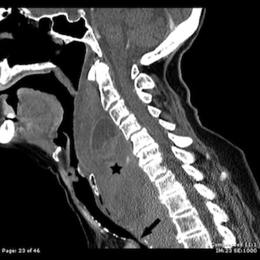 Contrast enhanced sagittal CT image shows a large retropharyngeal haematoma (star) extending from the C2 vertebral level to below the level of the sternal notch with tracheal compression (arrow)