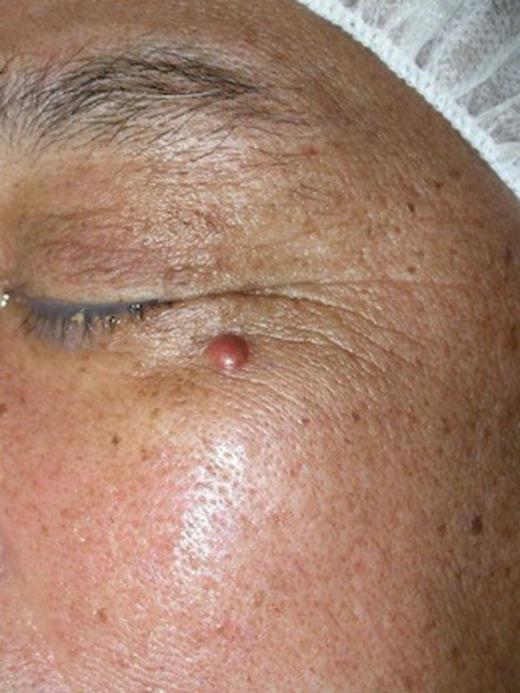 Clinical examination revealed a reddish-pink, firm, dome-shaped nodule measuring 8×6 mm