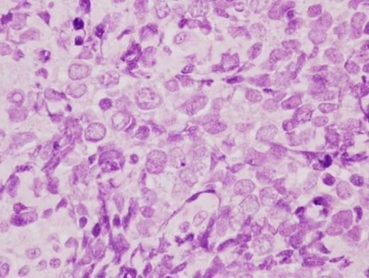 Histological examination showed groups of small cells with large nuclei and small cytoplasms in the dermis (H.E. ×200)